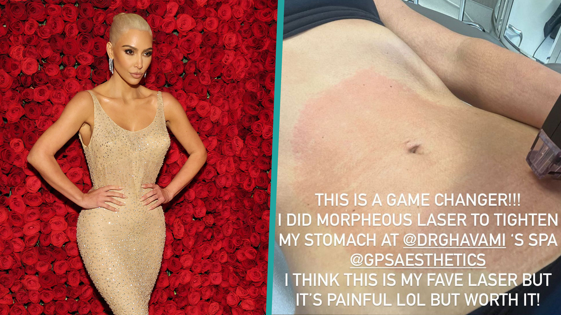 Kim Kardashian Reveals She Had “Painful” Stomach Tightening Procedure