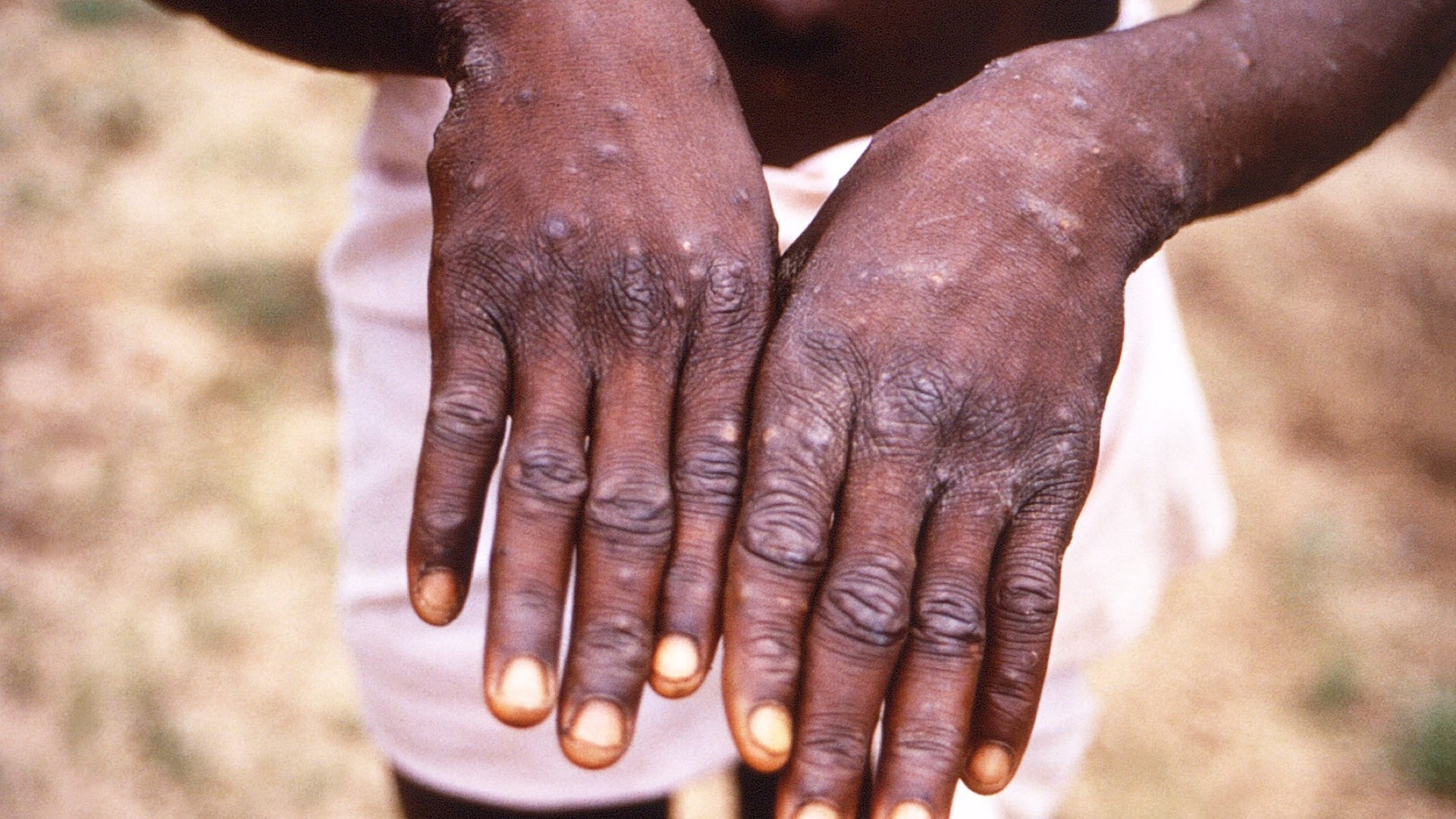 Watch TODAY Excerpt How to identify a monkeypox rash Symptoms to look