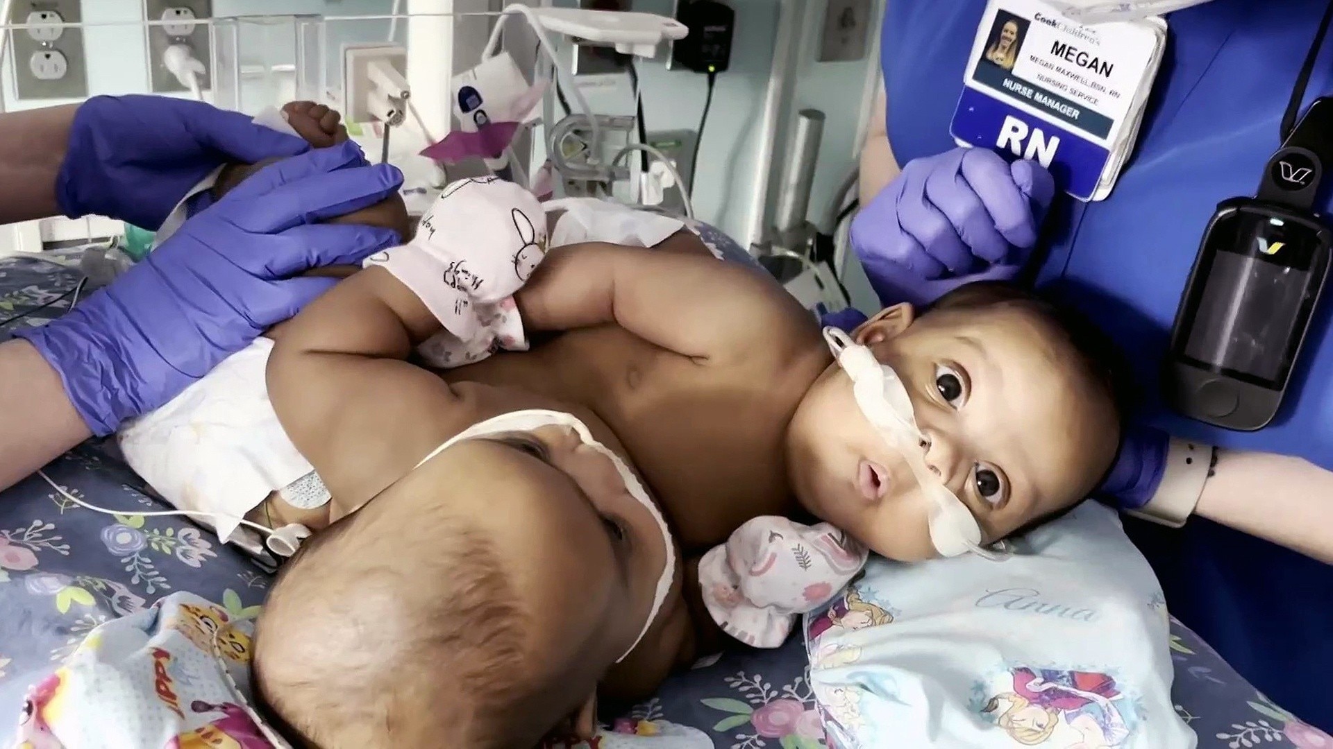 Watch Today Excerpt Conjoined Twins Successfully Separated In Rare Surgery 